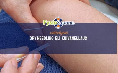 Dry Needling eli kuivaneulaus hieronnan lisäpalveluna